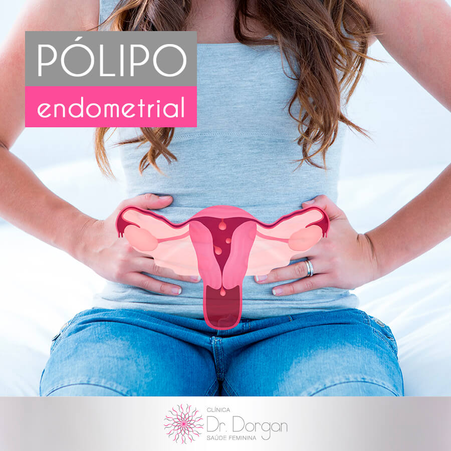 eliminar-polipo-endometrial-de-forma-natural-aulaiestpdm-blog